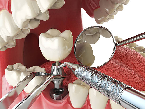 Best Emergency Root Canal Treatment in Millersburg, OR